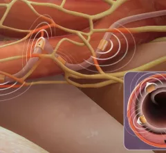 The Medtronic Symplicity Spyral Renal Denervation system uses a catheter that curls in the renal artery to place radiofrequency electrodes against the vessel wall to ablate the nerves that control vasodilation, so the artery can be propped in the fully open position.