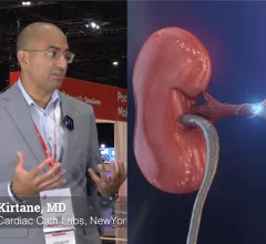 Ajay J. Kirtane, MD, director of the cardiac catheterization laboratories and professor of medicine at NewYork-Presbyterian/Columbia University Irving Medical Center, explains the current trial data on catheter renal denervation to treat drug-resistant hypertension at AHA 2022. 