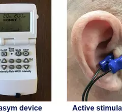 Ear-clip device offers non-pharmacological treatment for postural tachycardia syndrome (POTS). #HRS2023 #HRS