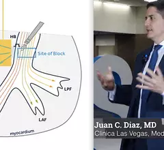 Juan Diaz, MD, explains why left bundle branch (LBB) conduction pacing is better than conventional sinus node pacing in cardiac synchronization therapy (CRT) for heart failure patients. #HRS #HRS2023 #LBBAP