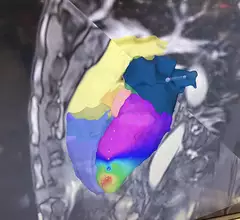 MRI-guided EP lab ablation procedure using mapping and MRI-safe catheters from Imricor, displayed at HRS 2023. Photo by Dave Fornell