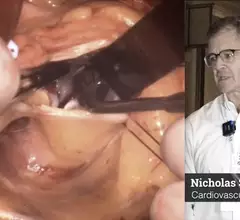 Photo of a surgical cardiac septal myectomy to treat hypertrophic cardiomyopathy (HCM). Nicholas Smedira MD discusses septal myectomy in HCM patients and the need for more detailed protocols for HCM care. #HCM #ASE #ASE2023 #myectomy