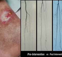 A diabetic foot ulcer that does not heal due to low blood supply from peripheral artery disease (PAD), and the before and after interventional angiograms of the patient's revascularization treatment. Images courtesy of Foluso Fakorede, MD