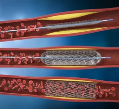 PCI interventional cardiology. The use of radial access during PCI procedures is increasing throughout the United States, and new data presented at the SCAI's annual meeting suggest that could be beneficial for patients. 