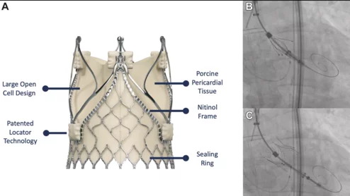Cardiologists make history, perform first-ever transcaval TAVR with a JenaValve Trilogy device for pure aortic regurgitation 