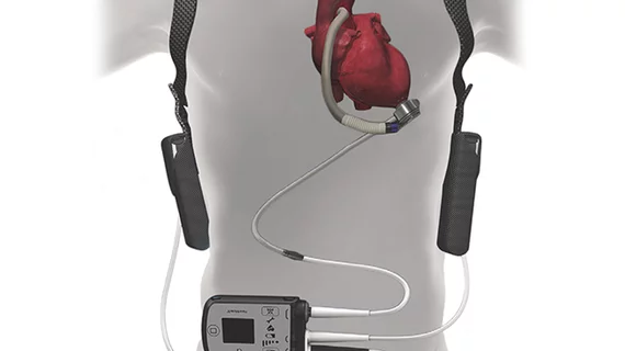 The Abbott HeartMate 3 left ventricular assist system. When Medicare updated its policy on left ventricular assist devices (LVADs) in 2020, making it easier for heart failure patients to receive an LVAD at a health center that does not perform heart transplants, the change was designed to improve patient access and boost outcomes. However, new research published in JAMA Network Open suggests shift may have potentially caused patients to miss out on heart transplants they would have otherwise received.