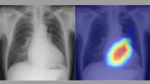 Artificial intelligence (AI) model using chest x-rays to evaluate cardiac function