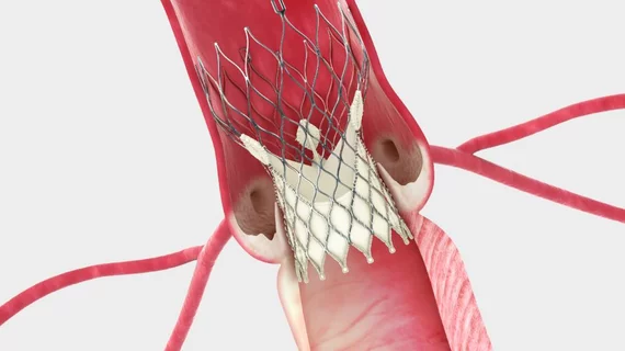 Transcatheter aortic valve replacement (TAVR) offers valuable lessons that can be applied to its mitral valve counterpart, according to imagers on the frontlines for both techniques. This ius being carried over into the complex anatomy involved in transcatheter mitral valve repair and replacement (TMVR).