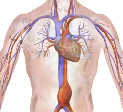 Abdominal aortic aneurysm
