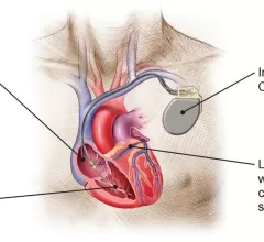 Cardiac resynchronization therapy with a defibrillator (CRT-D) can be used to significantly improve mortality and hospitalization rates among older heart failure patients. CRT-D illustration courtesy of Boston Scientific.