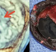 Examples of prosthetic heart valve thrombus formation on the valve leaflets. A new study shows better outcomes using tPA vs. surgery to remove the clots. Valve thrombosis. Images from Mayo Clinic