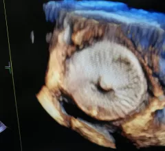 View of an Amulet left atrial appendage (LAA) occluder on 4D intra-cardiac echo (ICE) from a GE NuVision ICE catheter. Since ICE is operated by the interventionalist, it can be used to reduce the number of people needed to perform an LAA occlusion procedure.  