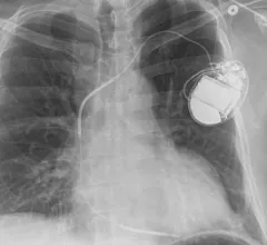 An implantable cardioverter defibrillator (ICD) and its associated leads viewed on a X-ray. Old leads are often abandon in veins and new ones added, but a new study of 1 million patients at ACC22 showed there is higher mortality if a device becomes infected and the leads are left behind. Image from RSNA.