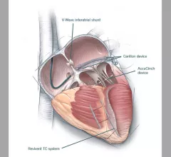 Illustration showing four innovative heart failure technologies: The V-Wave interaterial shunt to relieve pressures between the left and right sides of the heart; the Carillon Transcatheter mitral valve annuloplasty system; the Revivent TC system and the AccuCinch device. Interventional cardiology heart failure cleveland clinic 