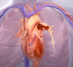 Terry Bowers, MD, director of vascular medicine at Beaumont Hospital, Royal Oak, Michigan, and national co-chair of the Pulmonary Embolism Research Collaborative (PERC), explains the skillset needed for pulmonary embolism (PE) thrombectomy procedures. #PERT #PE