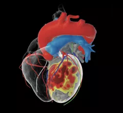 inHEART Medical, an international healthcare company with offices in France and the United States, has received clearance from the U.S. Food and Drug Administration (FDA) for its new 3D visualization software designed to improve the management of ventricular tachycardia (VT) ablation and other cardiac ablation procedures.