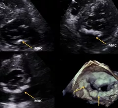 Examples of mitral annulus calcification (MAC) visualized using echocardiography. Image from the journal Echocardiography. 