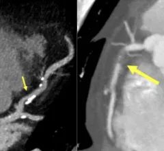 Examples of new plaque reporting in the CAD-RADS 2.0 document. Left, an example from CAD-RADS 2 / P2 plaque burden with mild coronary stenosis (25-49%). Right, example of a CAD-RADS 5/ P3, with a focal, non-calcified occlusion of the proximal RCA (arrow) and severe amount of plaque (P3). #CADRADS #YesCCT #CTA #CCTA 