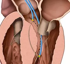 Adam Greenbaum, MD, transcatheter electrosurgery to prevent left ventricular outflow tract (LVOT) obstruction using a new procedure called Septal Scoring Along the Midline Endocardium (SESAME). The transcatheter procedure mimicking surgical myotomy.