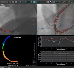Example of QFR technology, which uses a rotation of the C-arm around the patient to create a 3D model and a color coded map showing the FFR values and drops in blood flow. 
