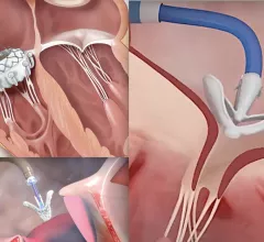 Three transcatheter tricuspid valve repair and replacement (TTVR) technologies that will likely see FDA clearance in. the next couple years include the Edwards Evoque transcatheter tricuspid valve (top left), Abbott TriClip (below) and the Edwards Lifesciences Pascal clip device (right).