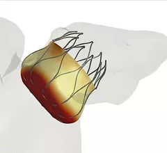 A FEOPS image of a Watchman LAA occluder device being checked for virtual sizing in an anatomical model of the patient's left atrial appendage. Dhanunjaya Lakkireddy, MD, explains the role and technology of LAA closure devices in managing AFib patients. 