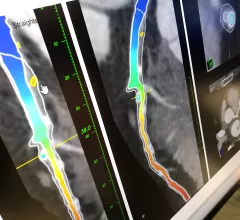 Example of fractional flow reserve (FFR) calculated using AI and assessment of the plaque in the vessel on a CT scan of the coronaries. This new type of FFR-CT was shown as a work-in-progress by the vendor Elucid. It was shown for the first time at AHA 2022.