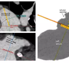 Images from the consensus document showing the proper left atrial appendage (LAA) sizing assessment for a transcatheter occluder device using transesophageal echo (TEE). Sizing and evaluation for pre-existing thrombus in the LAA also can be performed using cardiac CT.