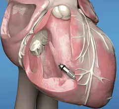 The Medtronic Micra leadless pacemaker implanted inside the heart. It is about the size of a large vitamin pill and is implanted using a catheter. 
