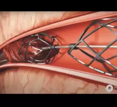 The Pounce Thrombectomy System by Surmodics. The company just gained FDA clearance on a new version of the system for smaller arteries. 