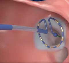 Medtronic's PulseSelect Pulsed Field Ablation (PFA) System 