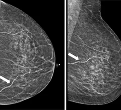 Breast arterial calcifications (BACs) identified on screening mammograms may help identify women who face a heightened risk of developing cardiovascular disease (CVD), according to a new analysis published in Clinical Imaging.