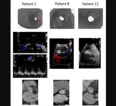 Virtual reality (VR) can help cardiologists plan for transcatheter aortic valve replacement (TAVR) procedures and predict the presence and severity of post-TAVR paravalvular leak (PVL), according to new research published in the Journal of Invasive Cardiology.[1]