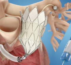 Transcatheter pulmonary valve replacement (TPVR) with Medtronic’s self-expanding Harmony valve is both safe and effective after more than a year, according to new real-world data published in the Journal of the American College of Cardiology.[1]