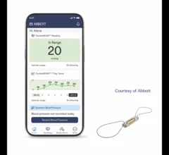 CardioMEMS Abbott heart failure