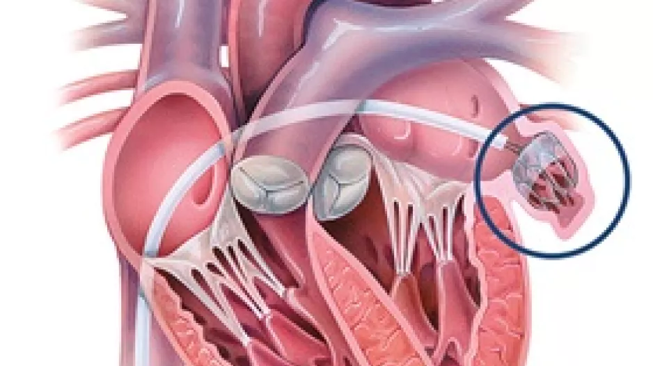 Illustration of a left atrial appendage occlusion (LAAO) procedure using a Watchman device. Image courtesy of Johns Hopkins Medicine. #LAA #LAAO