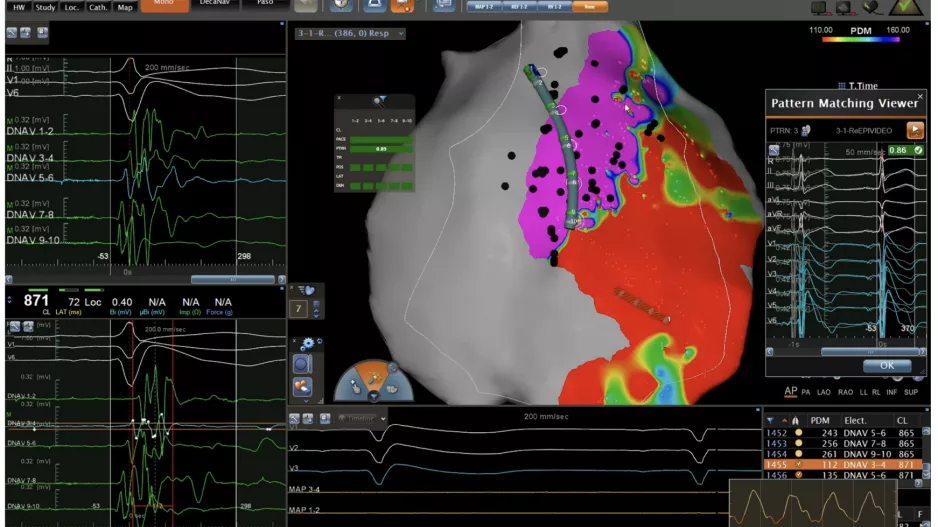 EP ablation mapping technology has greatly improved in the past decade. 