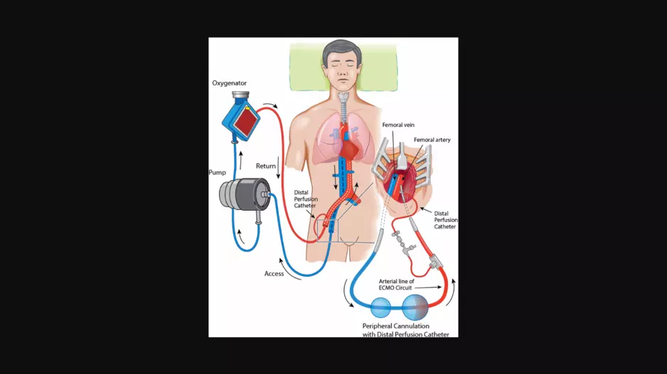 Extracorporeal CPR refractory out-of-hospital cardiac arrest