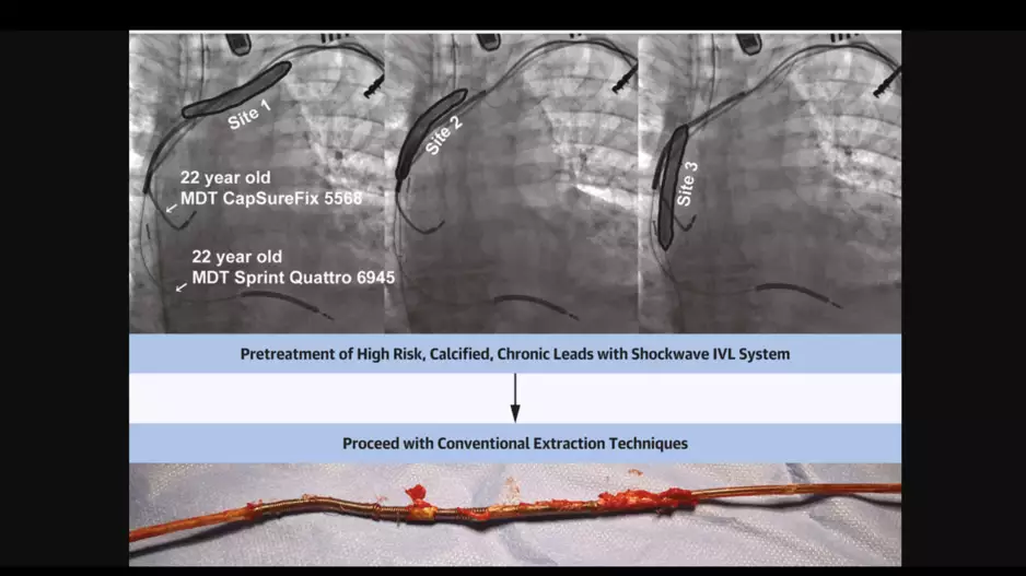 Shockwave Medical's intravascular lithotripsy used during transvenous lead extraction