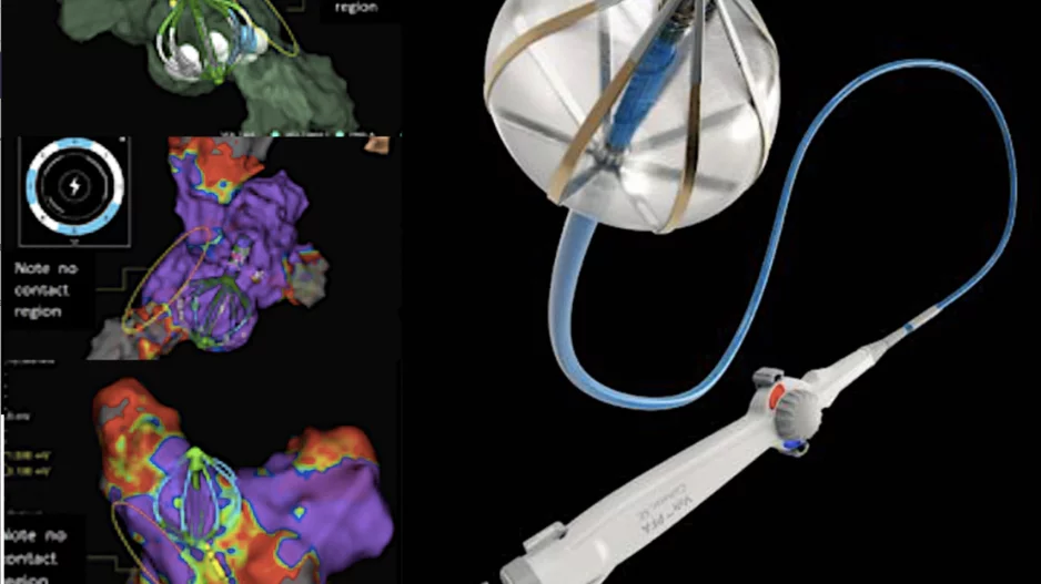 Pre-clinical images of the Abbott Volt pulsed field ablation system creating lesions using electroporation, presented at the 2023 AHA Scientific Sessions, The Abbott PFA system is now being used in a first-in-human study at the Centre for Heart Rhythm Disorders at the University of Adelaide, Australia.