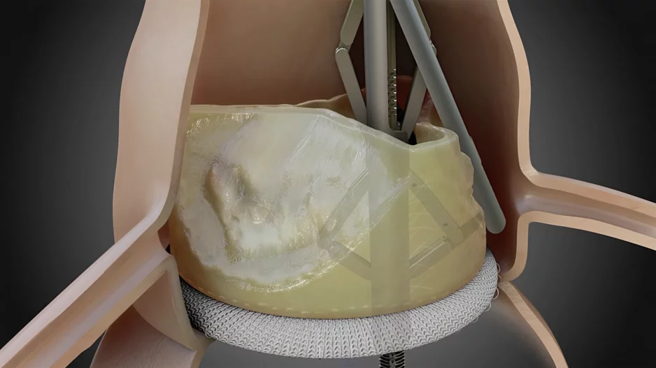 Pi-Cardia ShortCut TAVR device. According to Pi-Cardia, ShortCut is the first medical device of its kind; interventional cardiologists use it to split valve leaflets in patients who have been recommended for valve-in-valve TAVR and face a heightened coronary obstruction risk.