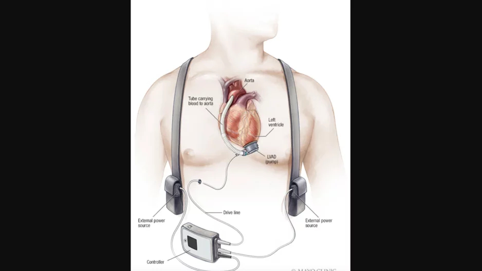Patient with LVAD