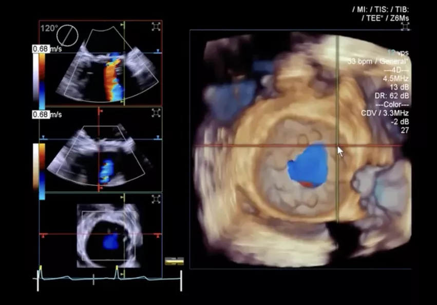 An example of 3D echocardiography showing the addition of advanced visualization aids overlaying the aortic valve for a structural heart evaluation of the mitral valve. The 3D/4D imaging also shows a mitral regurgitation jet. Example of Siemens 3D-4D technology.