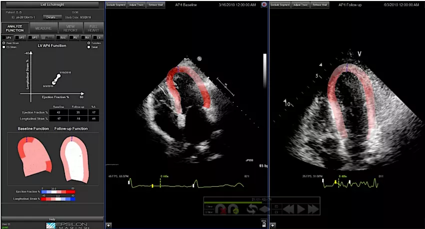 An example of myocardial strain strain imaging, which is becoming more widely used to complement overall interpretation of echo exams and to help identify infiltrative heart diseases. Example of cardiac strain from Epsilon Imaging.