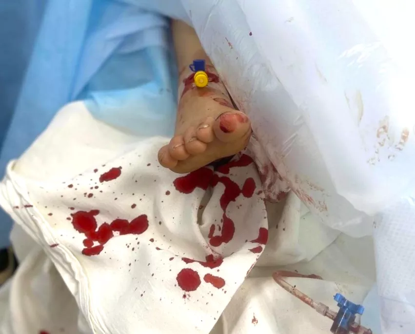 A pediatric patient who was wounded in the fighting in Kyiv, Ukraine, being treated at the National Children's Specialized Hospital. Photo released by the National Children's Specialized Hospital. #Ukraine #ukraineRussianwar #standwithukraine #civiliancasualties