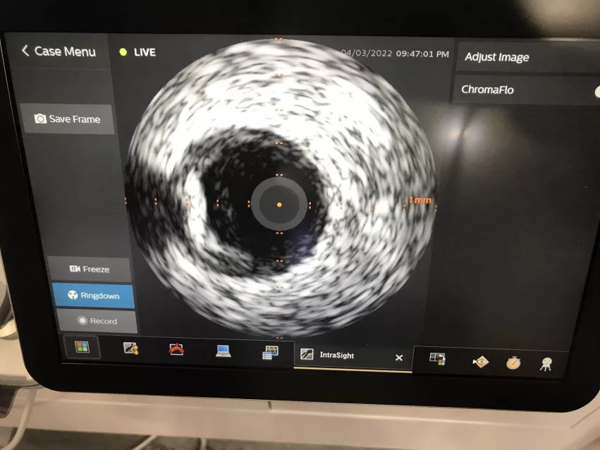 FFR and IVUS were compared for the first time in a trial at ACC22, which found both are good at determining if a stent was needed in the cath lab in intermediate risk patients.
