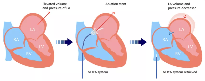 Percutaneous radiofrequency ablation–based interatrial shunting could be a safe and effective treatment option for patients with heart failure with preserved ejection fraction (HFpEF), according to new first-in-man study published in Circulation: Heart Failure.