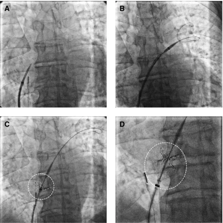 Fluoroscopy images of the first-in-man study of a new intra-atrial septal shunt to lower pressures between the upper chambers of the heart in heart failure patients. The series shows the positioning of an RF ablation catheter to cut a hole between the chambers and deployment of a stent structure to enlarge the hole. Image courtesy of Sun et al. and Circulation: Heart Failure.