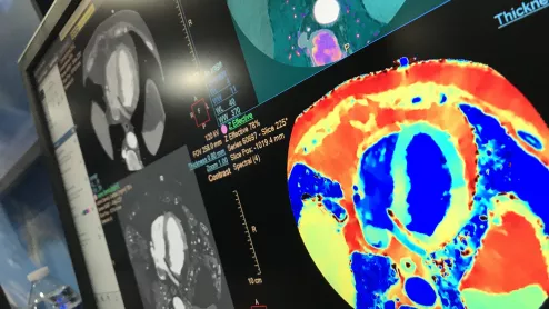 A spectral CT image of the heart showing ischemia in the myocardium by mapping the iodine density in the tissues as a surrogate for bloodflow. Example is from Philips Healthcare, displayed at the 2022 ACC meeting. Example of cardiac perfusion imaging. #SCCT