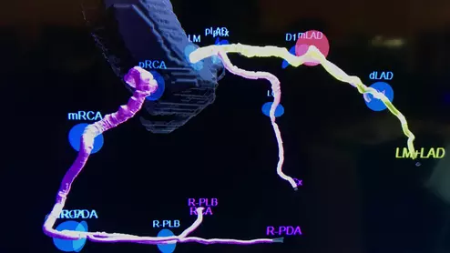 AI-generated coronary tree from a patient's CT scan showing a color code of areas of interest for plaque burden from the Cleerly software shown at SCCT 2022.